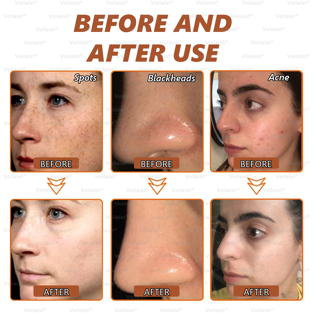 🏵️ Voilaist® Whitening and Spot-Removing Face Mask Suitable for face and body – 👩⚕️ Natural ingredients permanently remove age spots, freckles, sun spots, and liver spots.