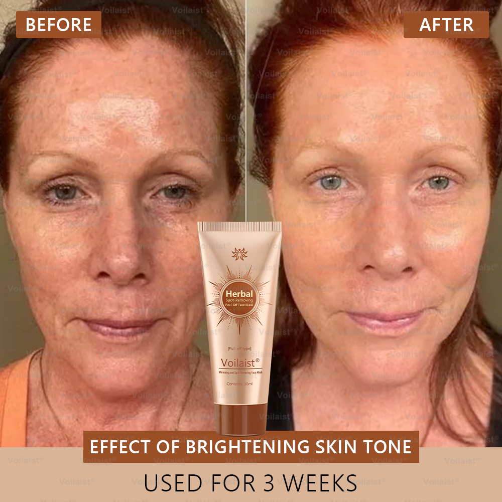 🏵️ Voilaist® Whitening and Spot-Removing Face Mask Suitable for face and body – 👩⚕️ Natural ingredients permanently remove age spots, freckles, sun spots, and liver spots.