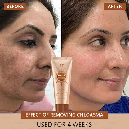 🏵️ Voilaist® Whitening and Spot-Removing Face Mask Suitable for face and body – 👩‍⚕️ Natural ingredients permanently remove age spots, freckles, sun spots, and liver spots.