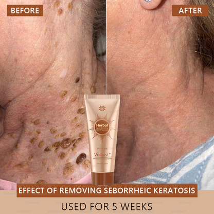 🏵️ Voilaist® Whitening and Spot-Removing Face Mask Suitable for face and body – 👩‍⚕️ Natural ingredients permanently remove age spots, freckles, sun spots, and liver spots.
