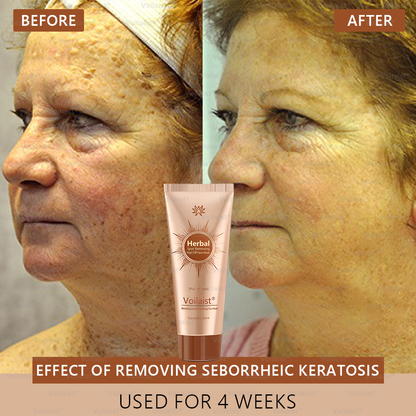 🏵️ Voilaist® Whitening and Spot-Removing Face Mask Suitable for face and body – 👩‍⚕️ Natural ingredients permanently remove age spots, freckles, sun spots, and liver spots.