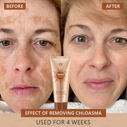 🏵️ Voilaist® Whitening and Spot-Removing Face Mask Suitable for face and body – 👩‍⚕️ Natural ingredients permanently remove age spots, freckles, sun spots, and liver spots.